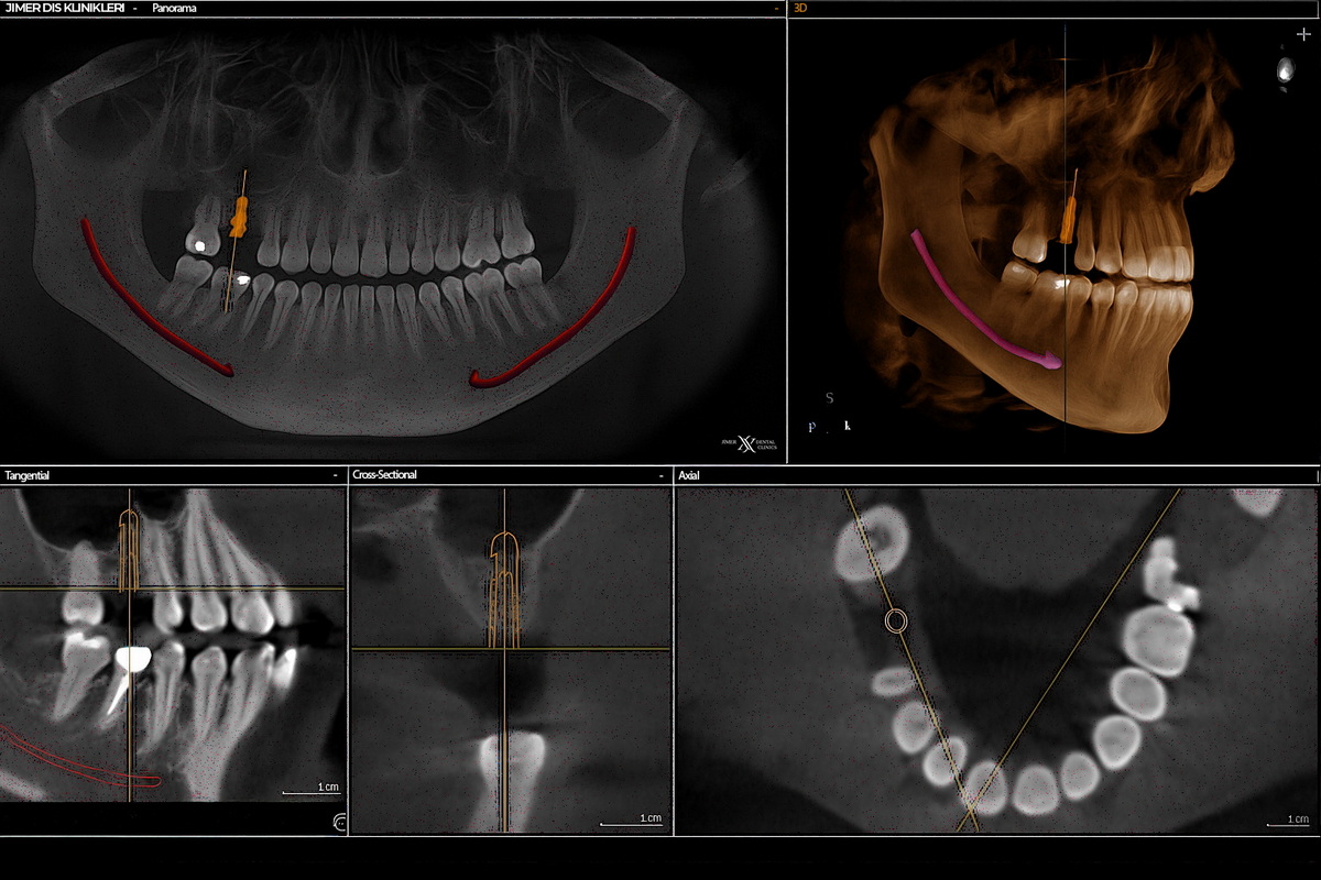 Dental Tomografinin Kullanım Alanları Dental Tomografinin Kullanım Alanları