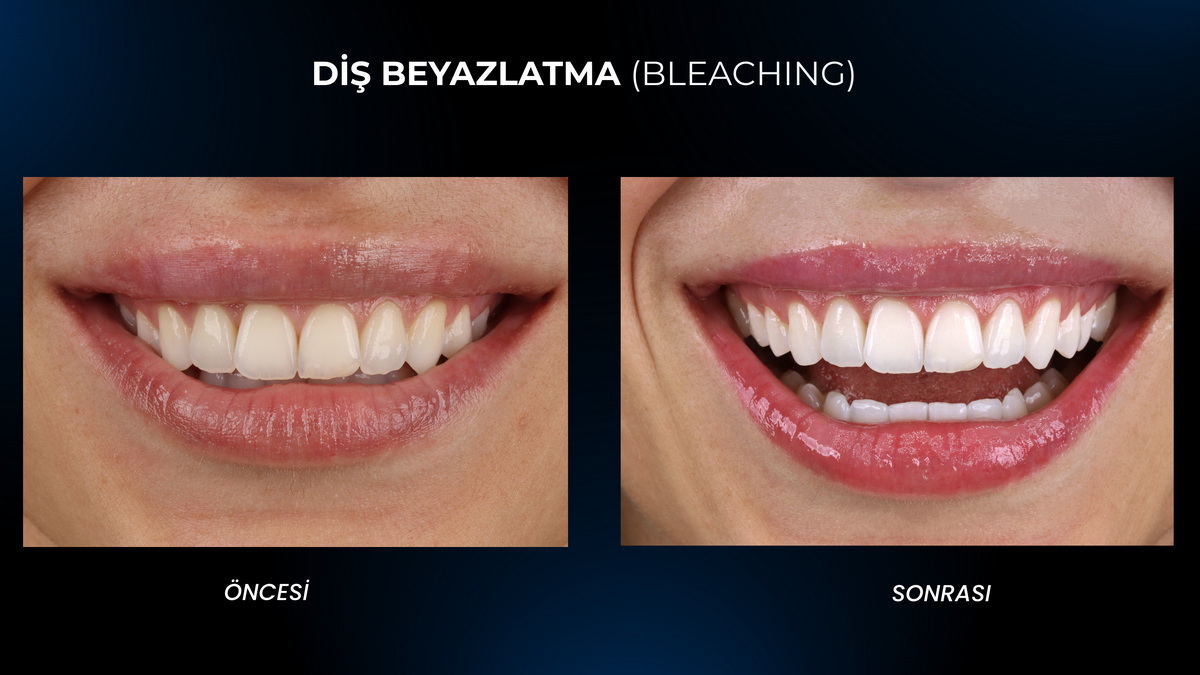 Bursa Diş Beyazlatma (Dental Bleaching) Bursa Diş Beyazlatma (Dental Bleaching)