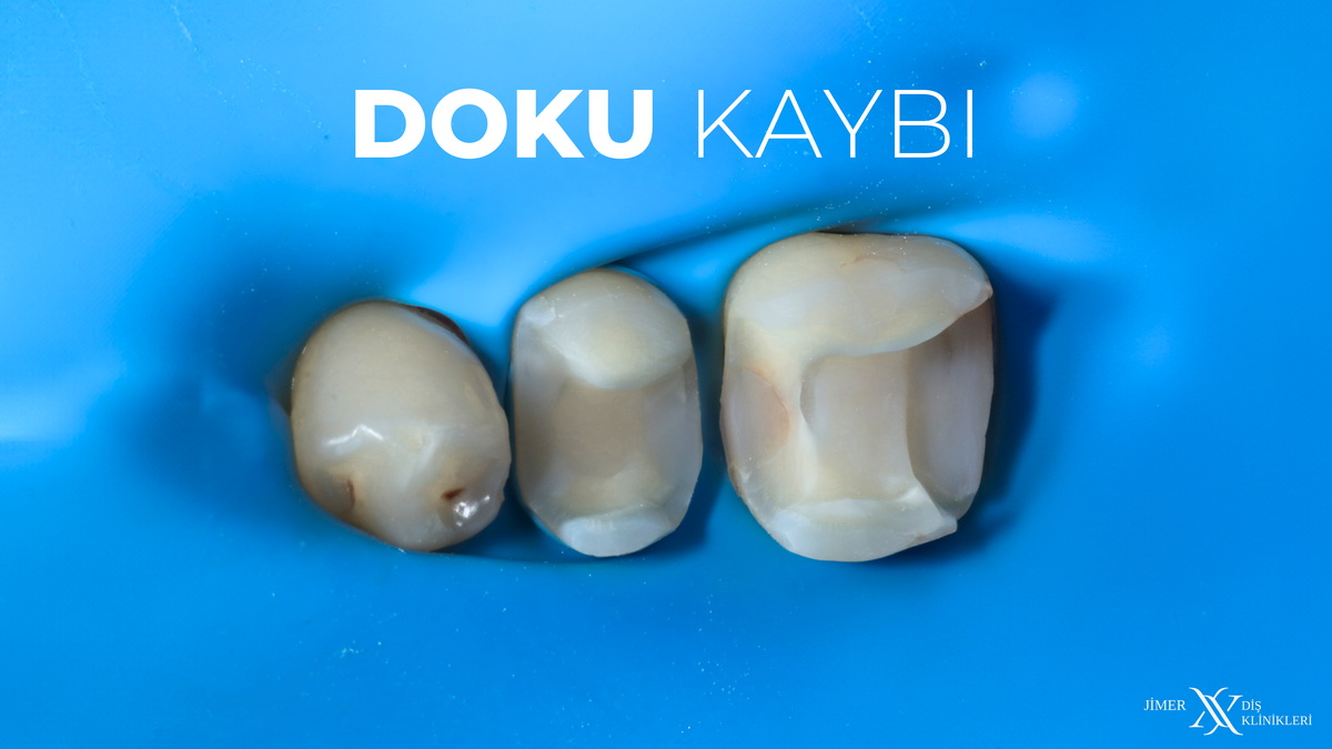 Dişteki Doku Kayıpları Nedir? Dişteki Doku Kayıpları Nedir?