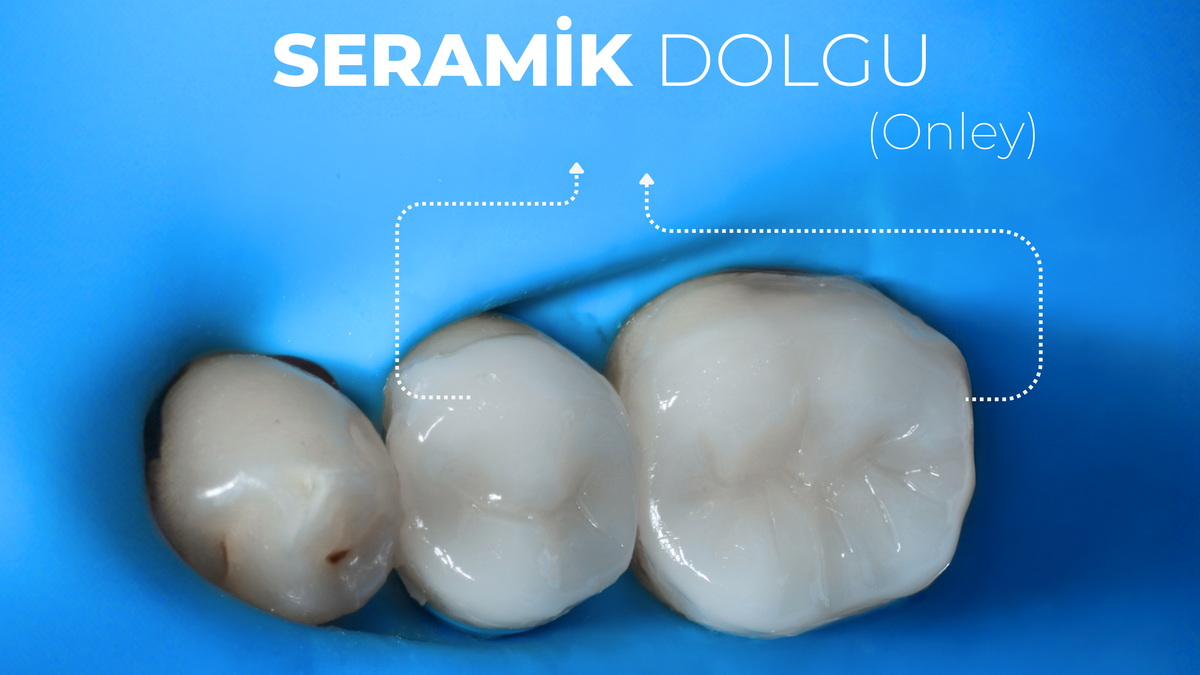 Inley-Onley Restorasyonlar Nedir? Inley-Onley Restorasyonlar Nedir?